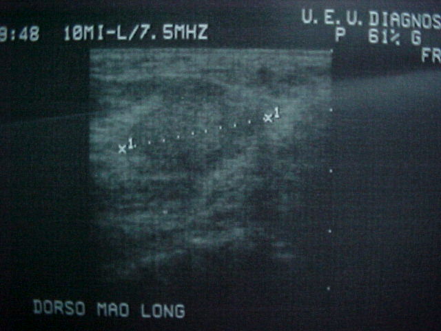 Figure 2 for case Glomus tumors